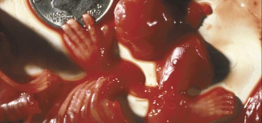 Части от абортирано бебе - ръце, крака и други