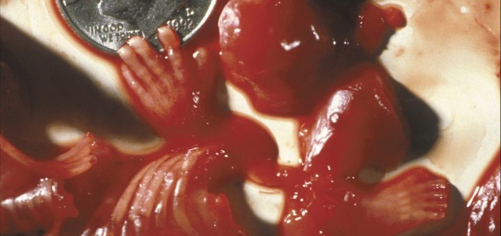 Части от абортирано бебе - ръце, крака и други