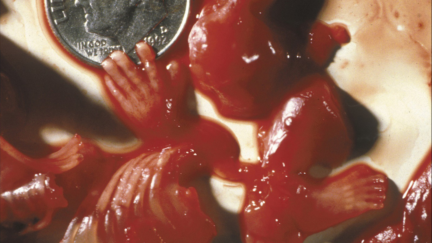 Части от абортирано бебе - ръце, крака и други